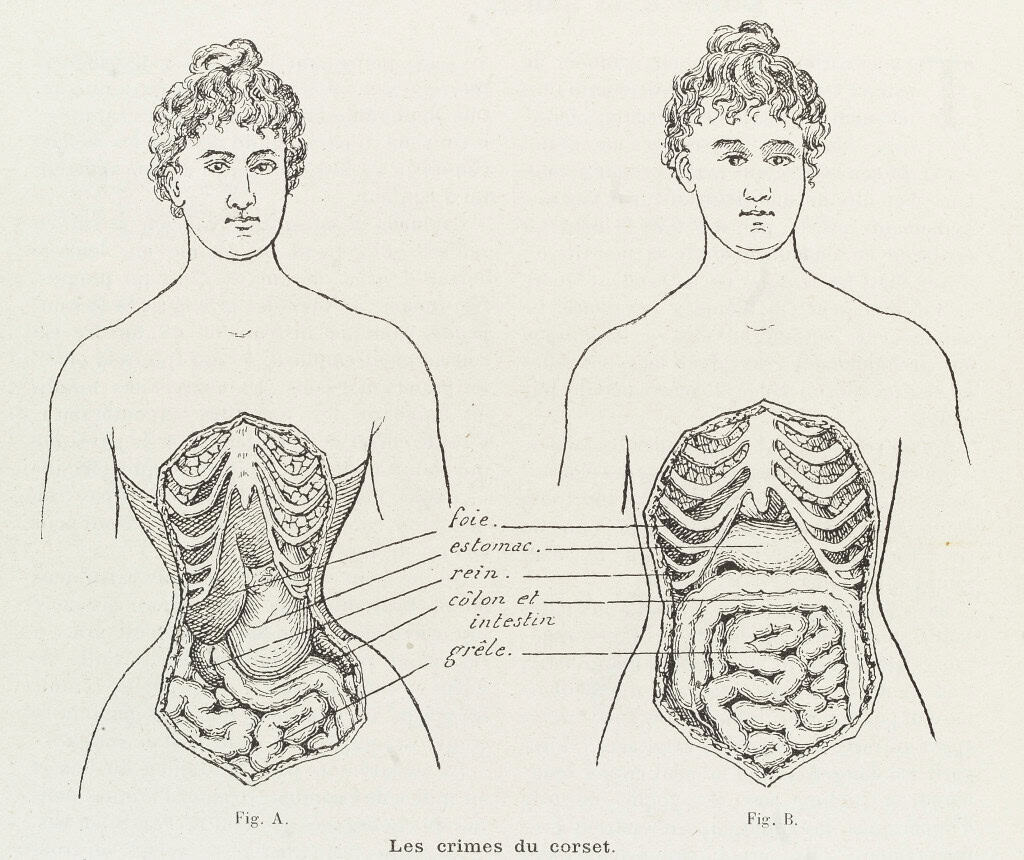 llustrations to denounce the crimes of the corset