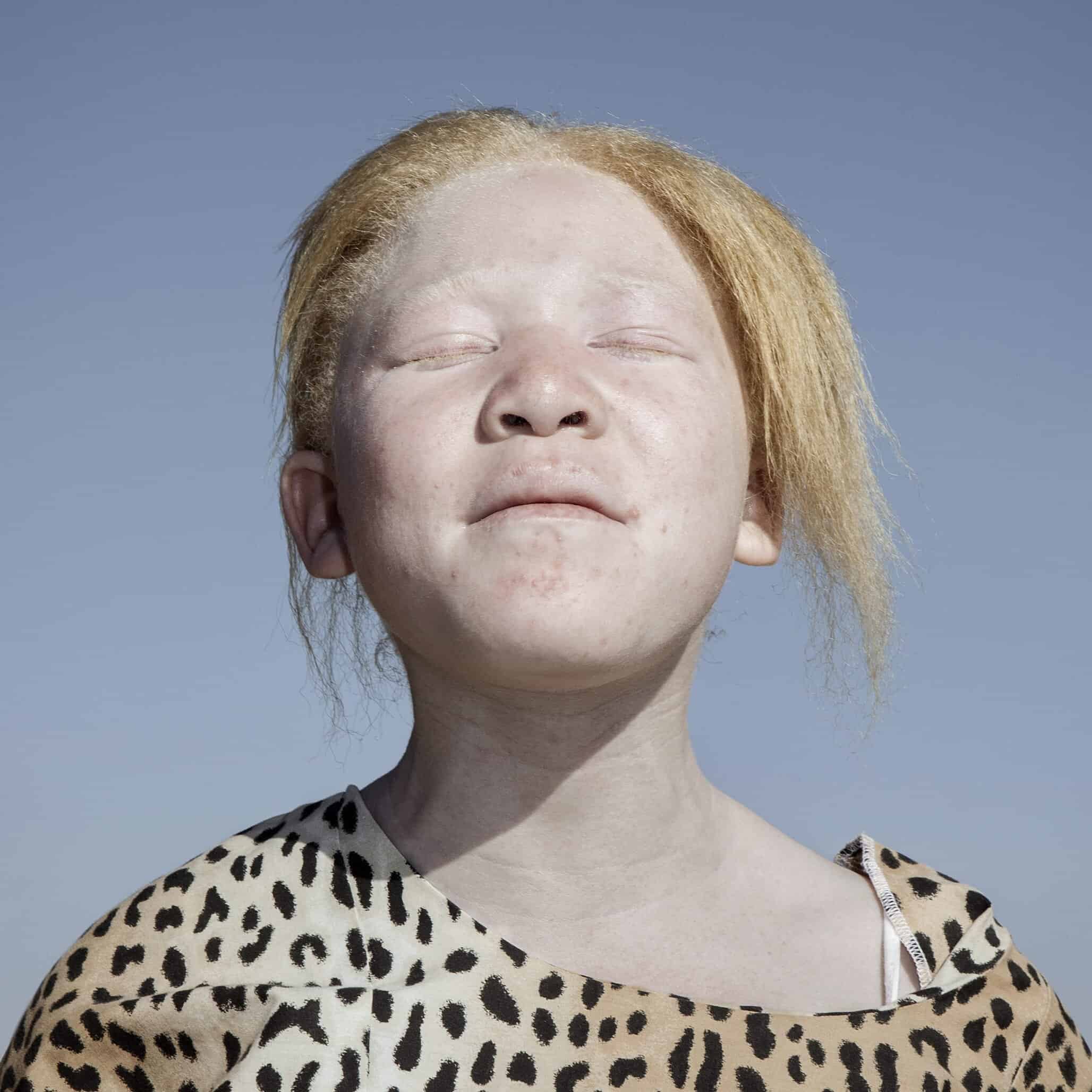 Rui Camilo: 34hours – A Call for Change
Bonnita, albino girl and student at Sibonile school for blind and visually impaired children in Johannesburg, South Africa